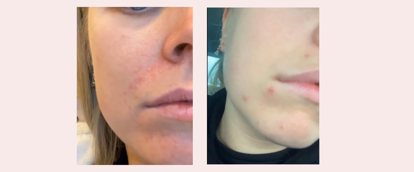 Før K-Beauty hudpleie