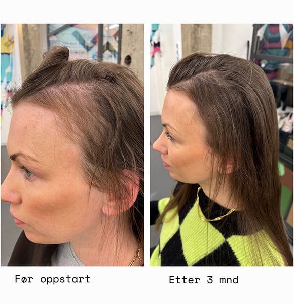 Før oppstart VS. etter 3  måneder med HAAR