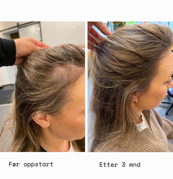 Før oppstart VS. etter 3 måneder med HAAR
