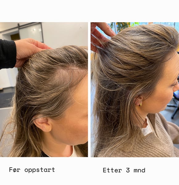 Før oppstart VS. etter 3  måneder med HAAR