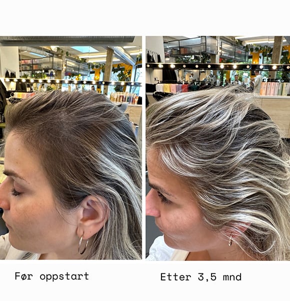 Før oppstart VS. etter 3 måneder med HAAR
