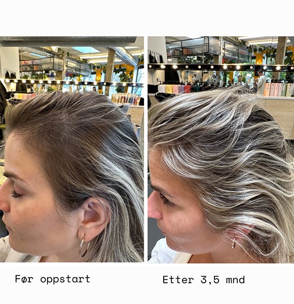 Før oppstart VS. etter 3  måneder med HAAR